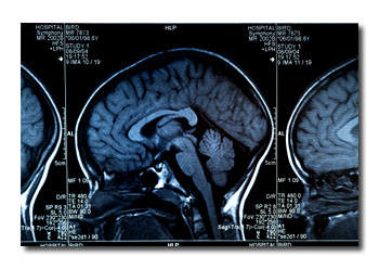 Traumatic Brain Injury (TBI) Animal Models & CRO Services - CRO Preclinical Research